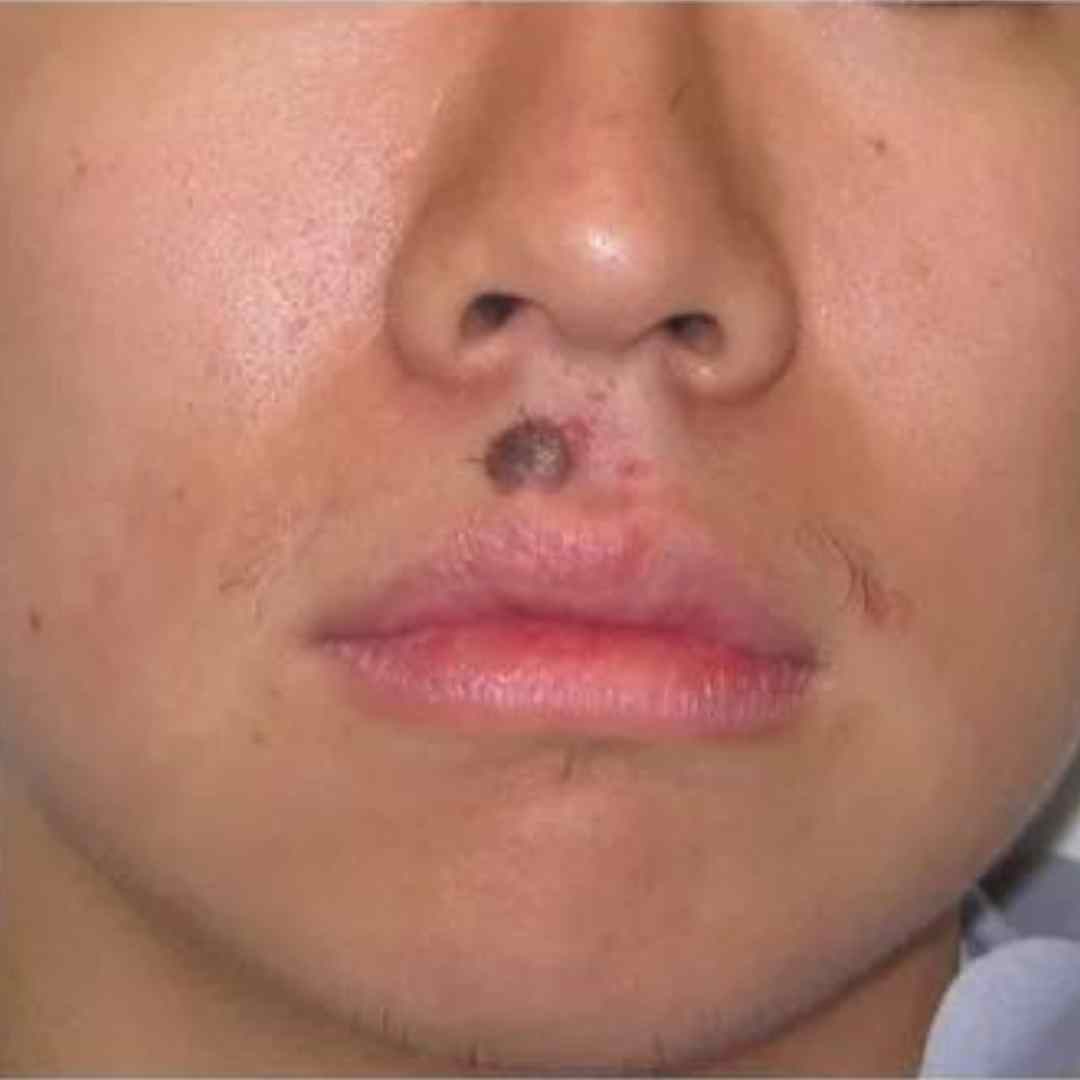 Before Pico Laser