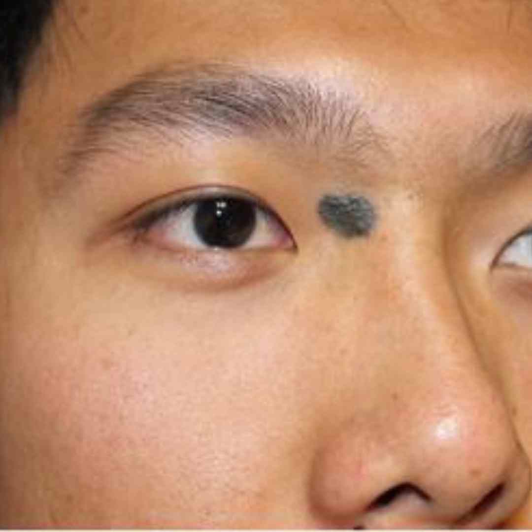 Before Pico Laser