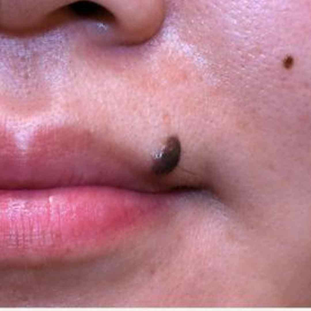 Before Pico Laser