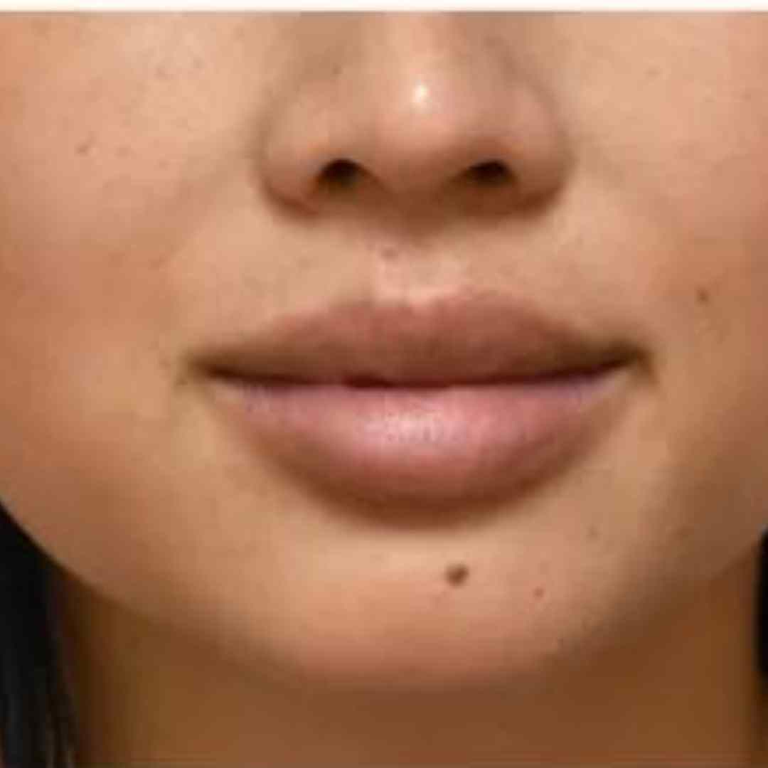 Before Pico Laser