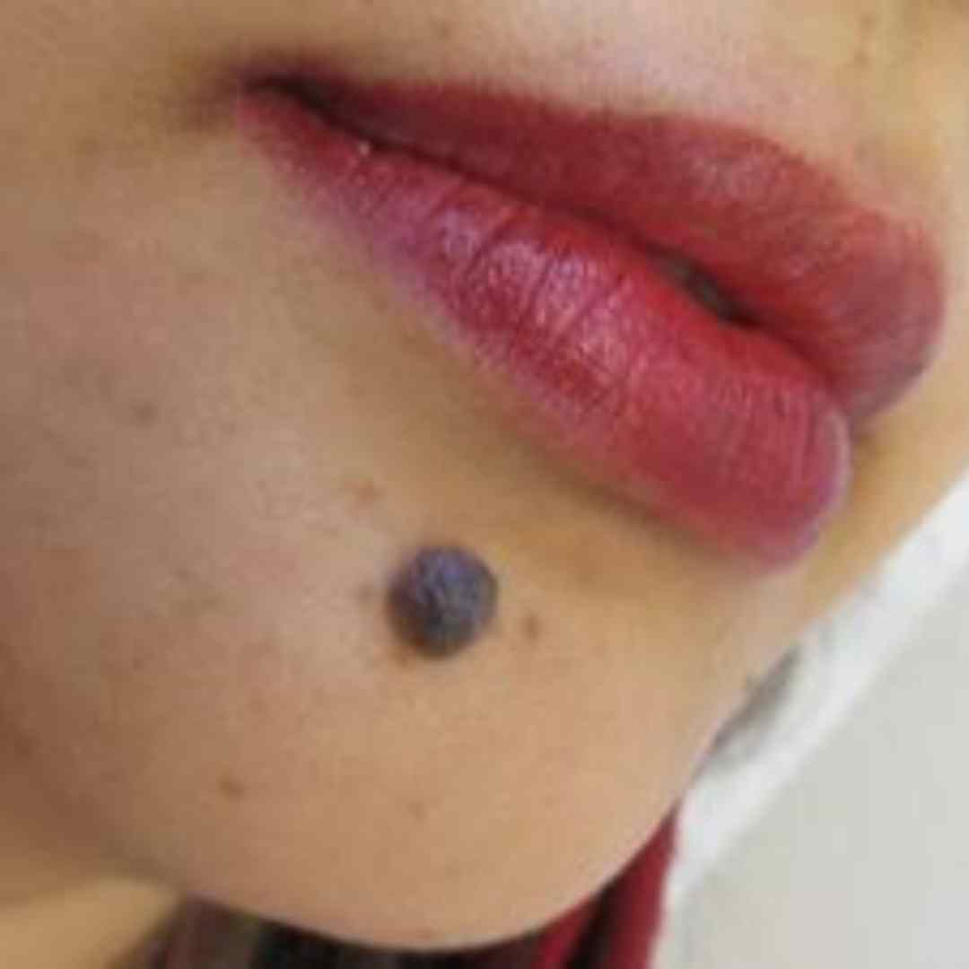 Before Pico Laser