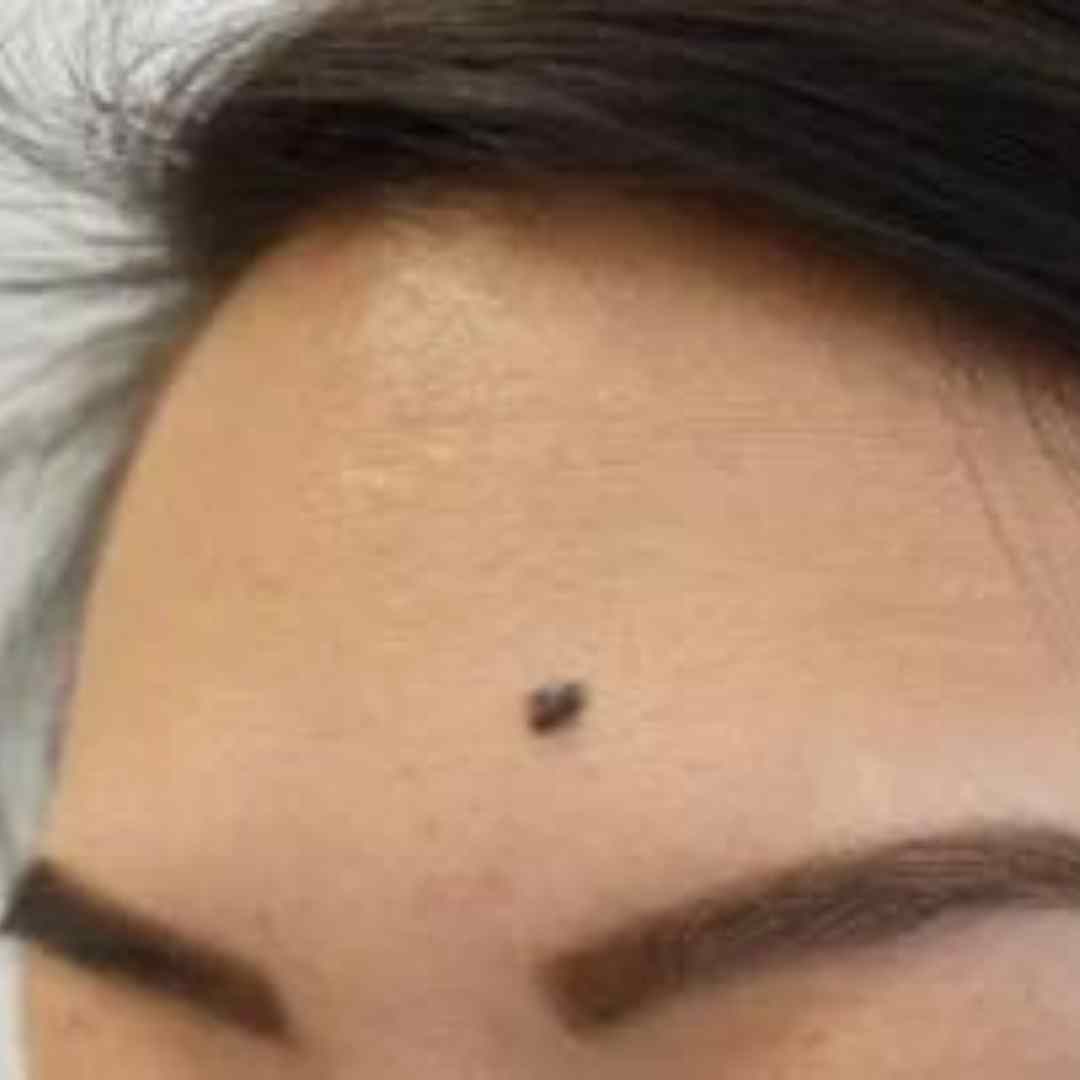 Before Pico Laser