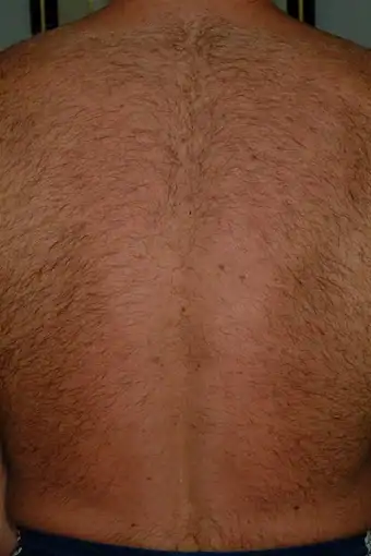 Pico Laser