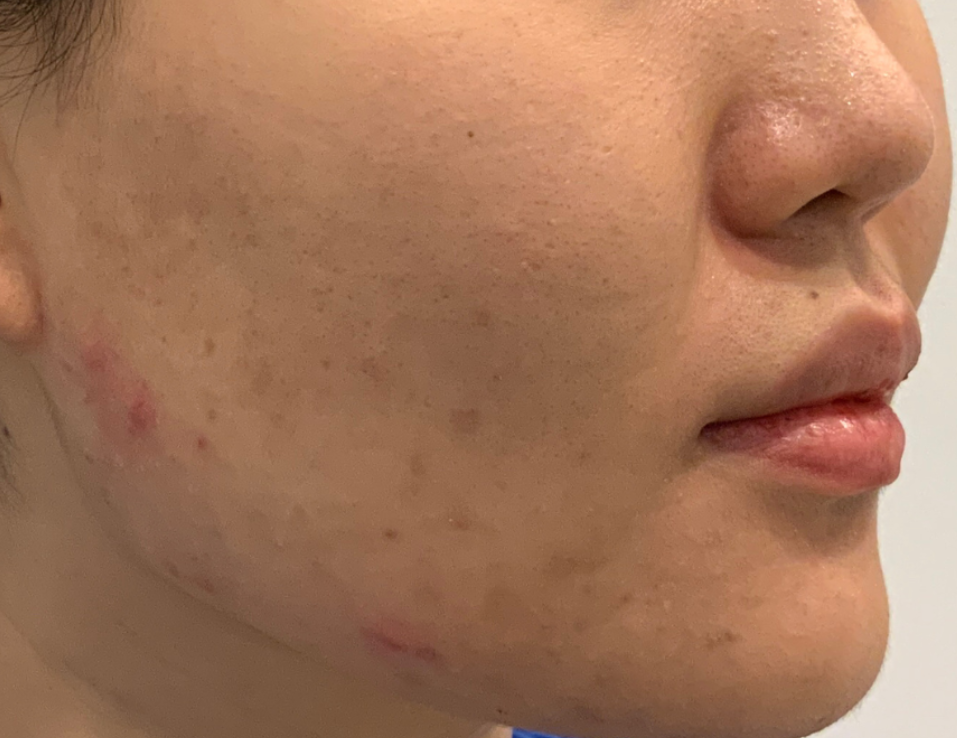 Pico Laser